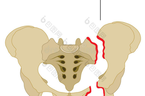 <strong>骨盆骨</strong>折