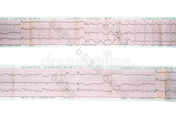 超声心动图读数轴视图，心电图，EKG