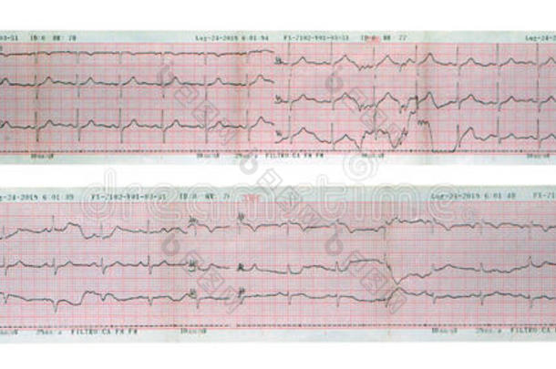 超声心动图(心电图，EKG)心脏读数