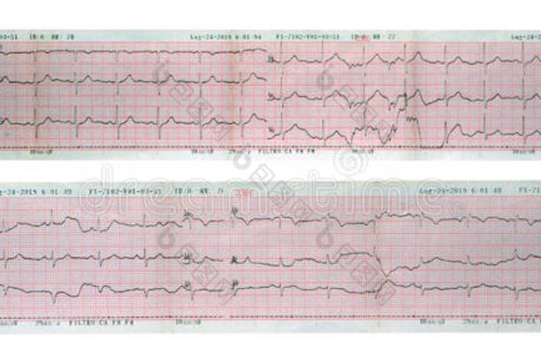 超声<strong>心动图</strong>(心电图，EKG)心脏读数