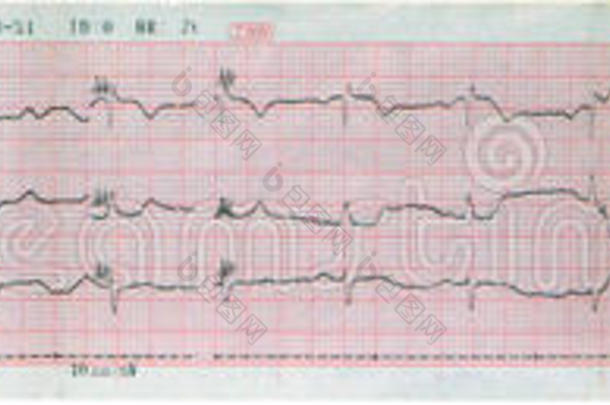 <strong>超声心动图</strong>(心电图，EKG)心脏读数