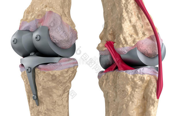 解剖学解剖踝关节关节炎关节病