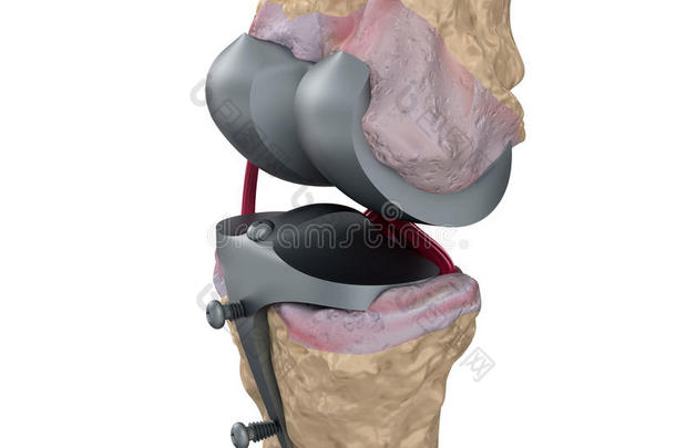 解剖学解剖踝关节关节炎关节病