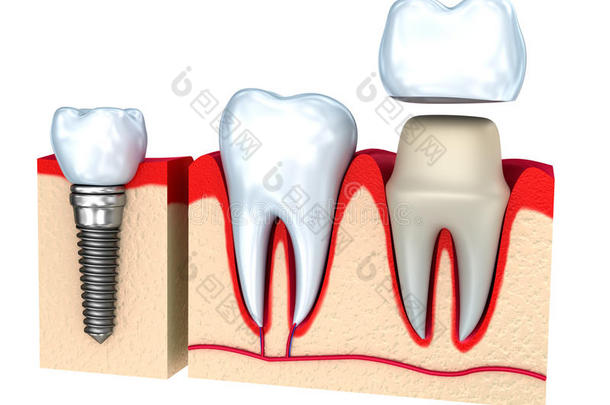 牙冠安装过程