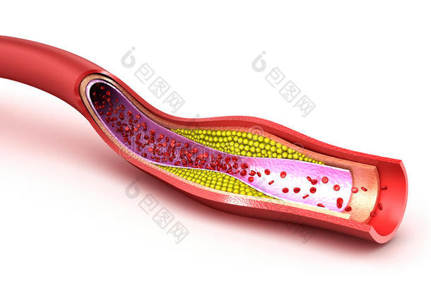 血管中的胆固醇斑块