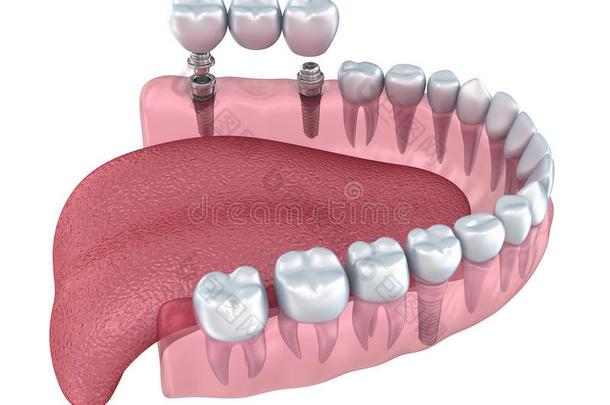 三维下牙和<strong>种植牙</strong>透明渲染