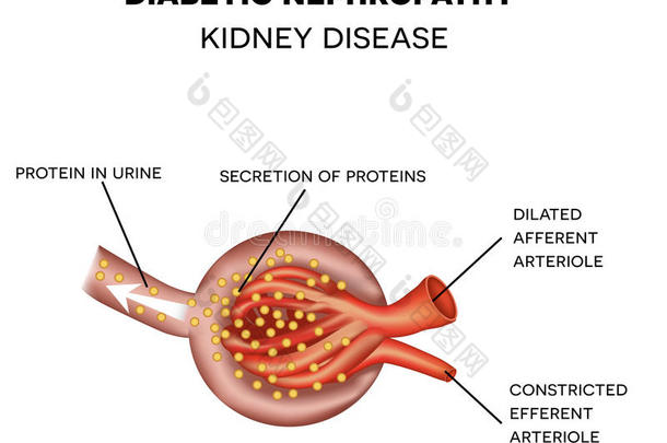 糖尿病<strong>肾</strong>病，<strong>肾</strong>小球<strong>解剖</strong>