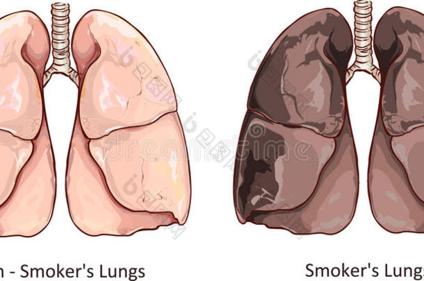 健康肺与吸烟者肺