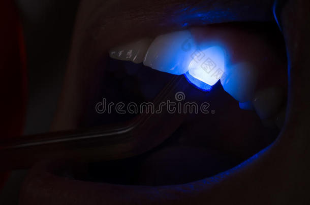 牙科紫外线设备压在牙齿上