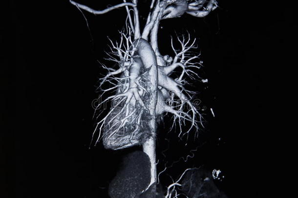 ct扫描血管造影(从胶片x射线拍摄照片)