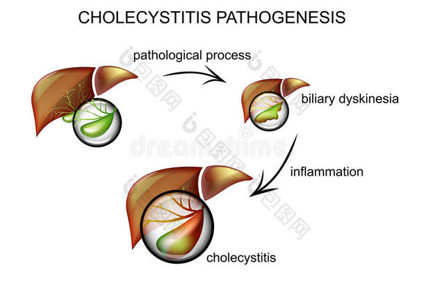胆囊炎发病机制。发病机制