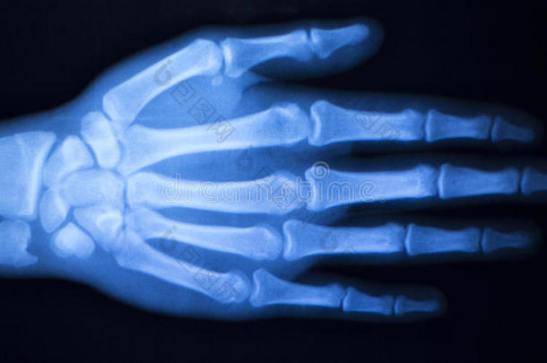 手指拇指<strong>医院</strong>X射线扫描