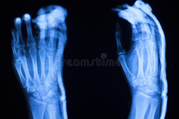 手指拇指医院X射线扫描