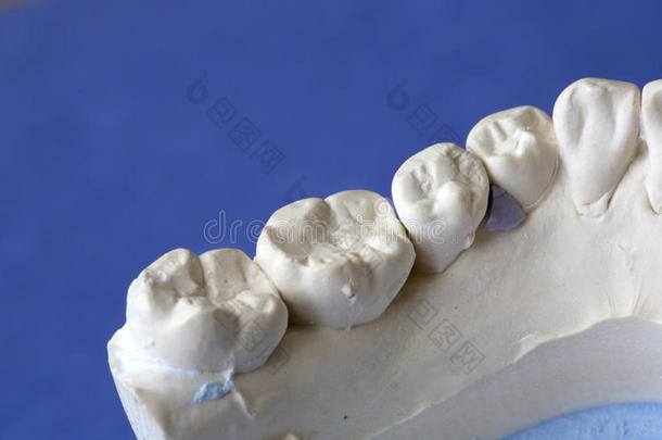种植牙人工模型