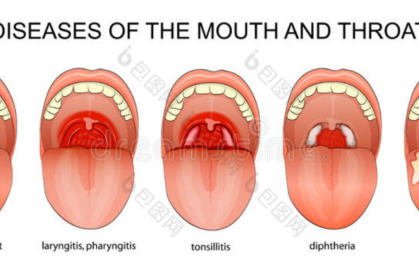 喉咙疾病