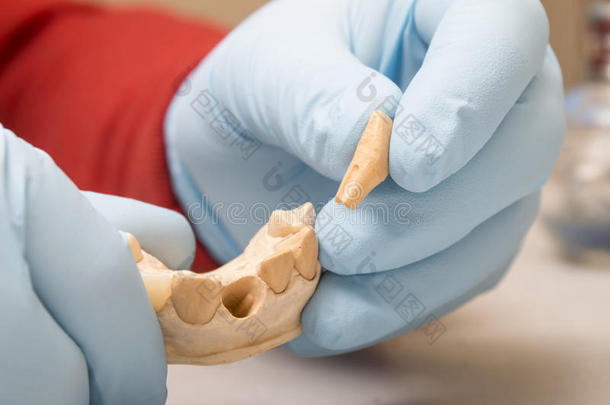牙科医生的手在种植牙