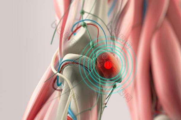显示膝关节<strong>损伤</strong>的解剖模型。