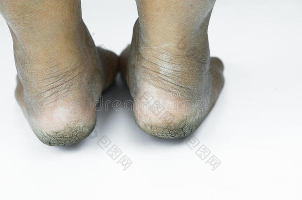 脏脚或开裂的高跟鞋隔离在白色背景，医疗或脚健康的人，医疗中心的高跟鞋或脚