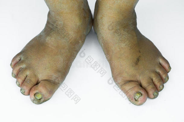 脏脚或开裂的高跟鞋隔离在白色背景，医疗或脚健康的人，医疗中心的高跟鞋或脚
