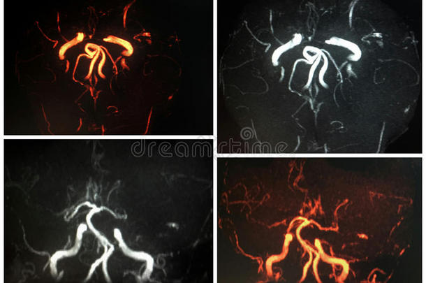 动脉瘤血管造影动脉人工制品双边的