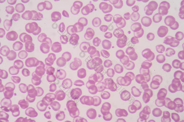 异常红细胞科学背景。