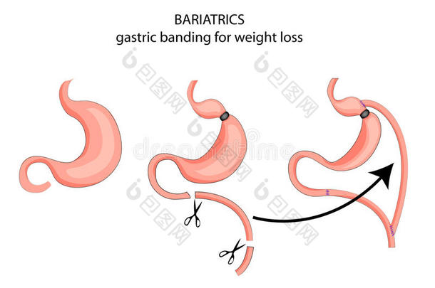 减肥药。以减肥为目标的胃束带