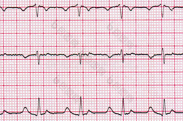 心电图。 图片的碎片