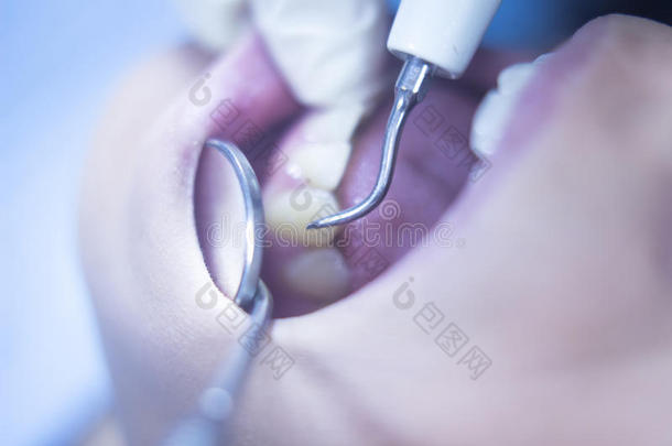 牙科病人口腔牙科检查