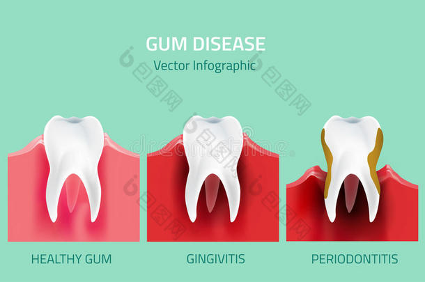 <strong>牙龈</strong>疾病阶段。 牙齿信息图