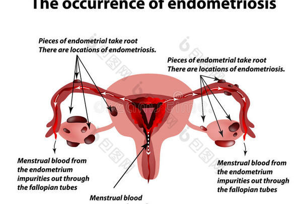 子宫内膜异位症。 子宫内膜异位症的出现。 子宫内膜。 信息图表。 矢量插图