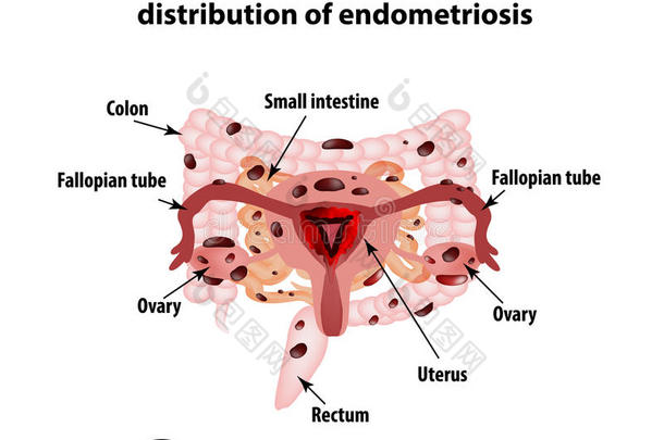 子宫内膜异位症。 子宫内膜异位症的出现。 子宫内膜。 结肠。 小肠。 信息图表。