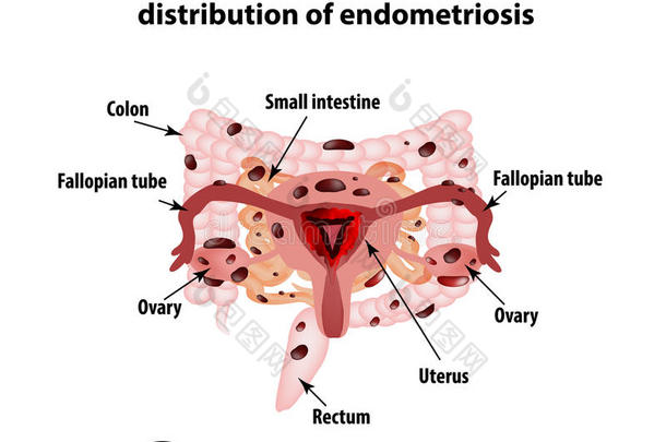 <strong>子宫</strong>内膜异位症。 <strong>子宫</strong>内膜异位症的出现。 <strong>子宫</strong>内膜。 结肠。 小肠。 信息图表。
