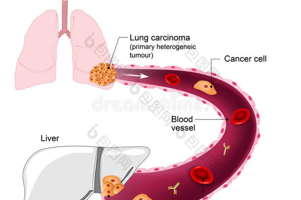 解剖生物学血身体癌症