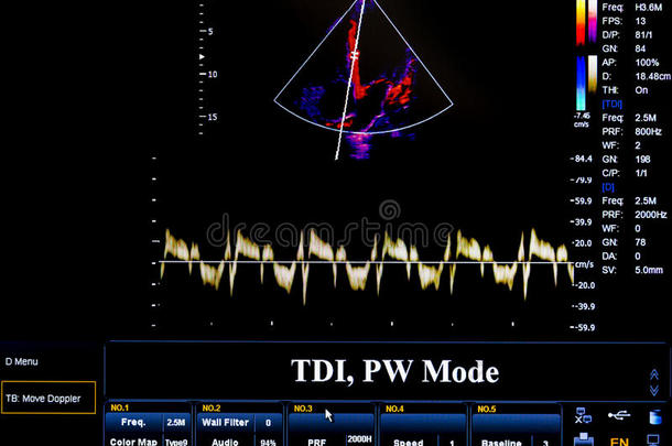 彩色<strong>超声</strong>监测图像。 TDI，PW模式