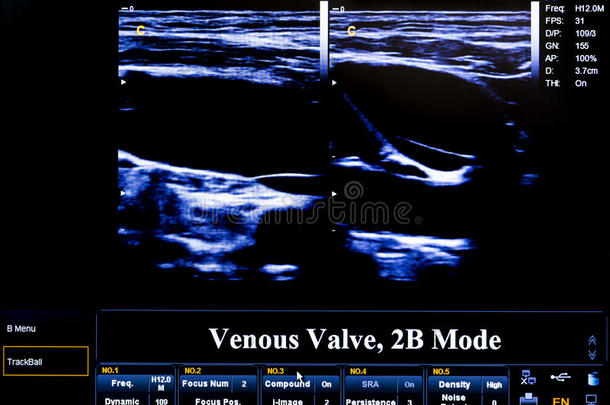 彩色<strong>超声</strong>监测图像。 静脉瓣膜