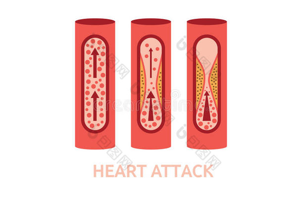 动脉攻击块心血管的照顾