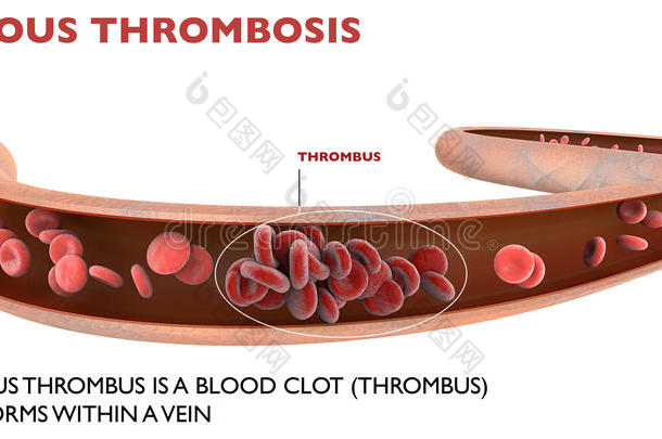 深静脉血栓形成