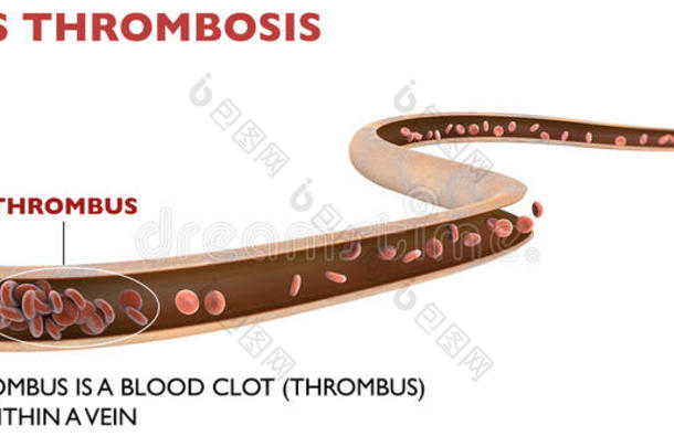 深静脉血栓形成