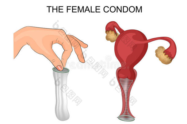 出生避孕套避孕避孕的控制