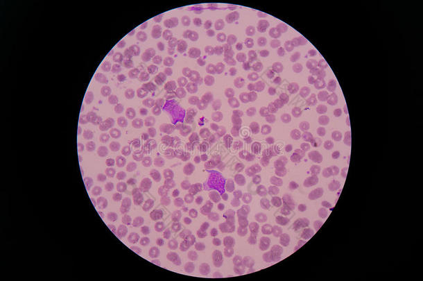 显微镜下血<strong>涂片</strong>显示WBC是典型的淋巴细胞。