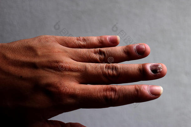 真菌感染指甲手，手指甲真菌病。 -集中注意力