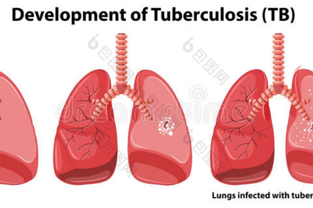 显示<strong>结核病</strong>发展的图表