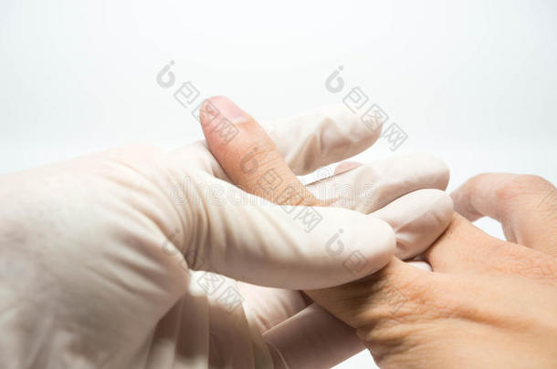 医生戴着检查手套，拿着病人的受伤手指