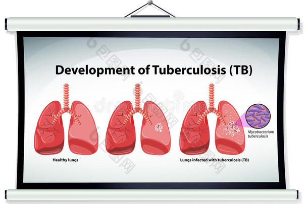 显示<strong>结核病</strong>发展的图表