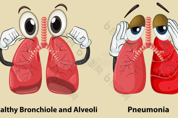 显示健康和<strong>肺炎</strong>肺的图表