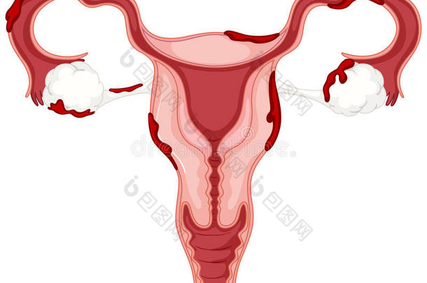 子宫<strong>内膜</strong>异位症妇女卵巢图
