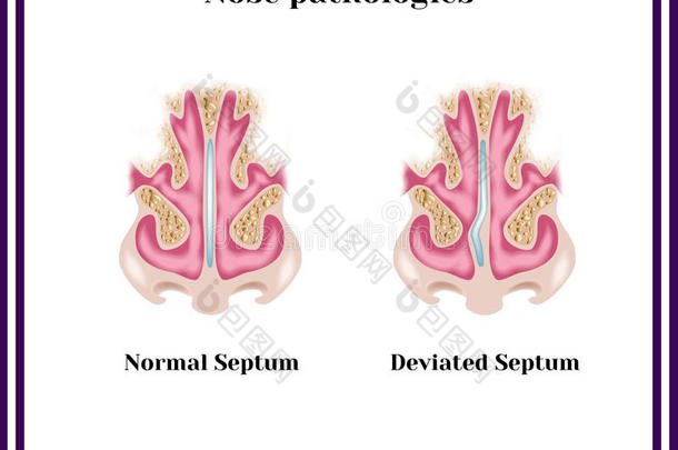 偏曲的隔膜。 鼻腔病理。