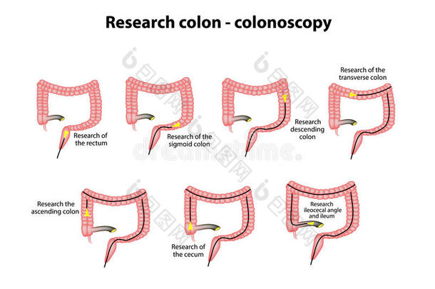结肠镜检查。 结肠的诊断。 信息图表。 背景上的矢量插图
