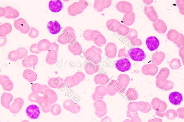 血液涂片在显微镜下显示白血病CLL