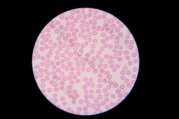 显微镜下血<strong>涂片</strong>显示正常红细胞。